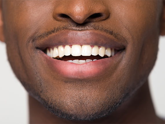 Before and after braces